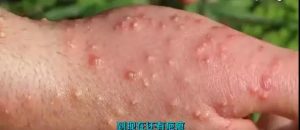 被紅火蟻咬后的特征